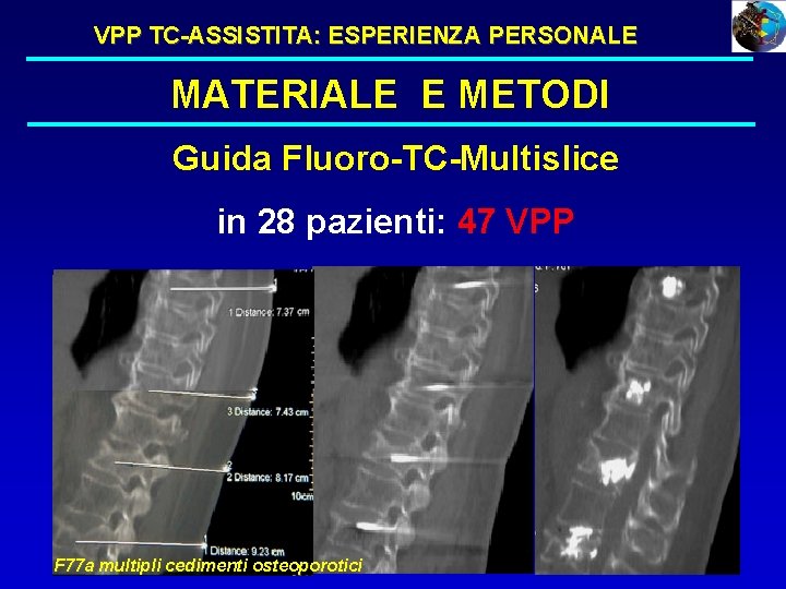 VPP TC-ASSISTITA: ESPERIENZA PERSONALE MATERIALE E METODI Guida Fluoro-TC-Multislice in 28 pazienti: 47 VPP