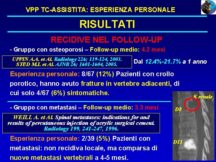 VPP TC-ASSISTITA: ESPERIENZA PERSONALE RISULTATI RECIDIVE NEL FOLLOW-UP - Gruppo con osteoporosi – Follow-up VPP TC-ASSISTITA: ESPERIENZA PERSONALE RISULTATI RECIDIVE NEL FOLLOW-UP - Gruppo con osteoporosi – Follow-up