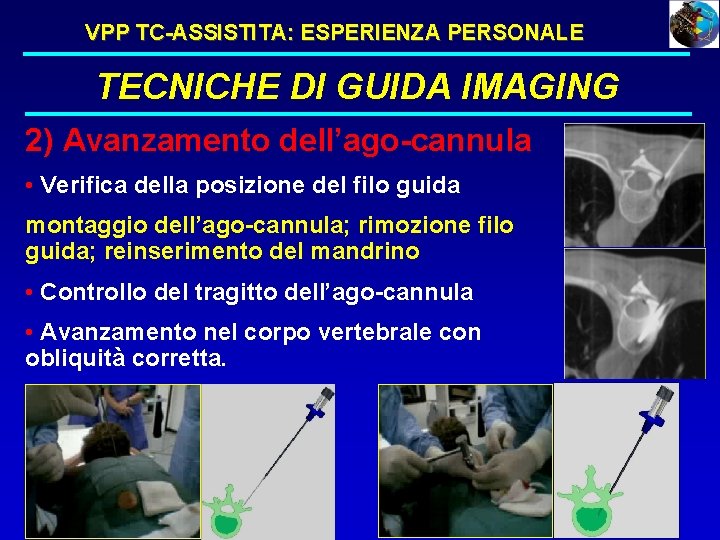 VPP TC-ASSISTITA: ESPERIENZA PERSONALE TECNICHE DI GUIDA IMAGING 2) Avanzamento dell’ago-cannula • Verifica della