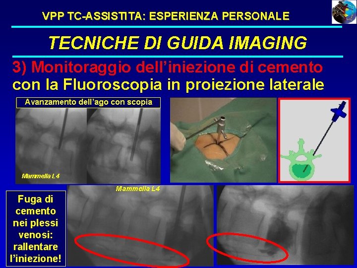 VPP TC-ASSISTITA: ESPERIENZA PERSONALE TECNICHE DI GUIDA IMAGING 3) Monitoraggio dell’iniezione di cemento con