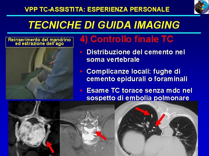 VPP TC-ASSISTITA: ESPERIENZA PERSONALE TECNICHE DI GUIDA IMAGING Reinserimento del mandrino ed estrazione dell’ago