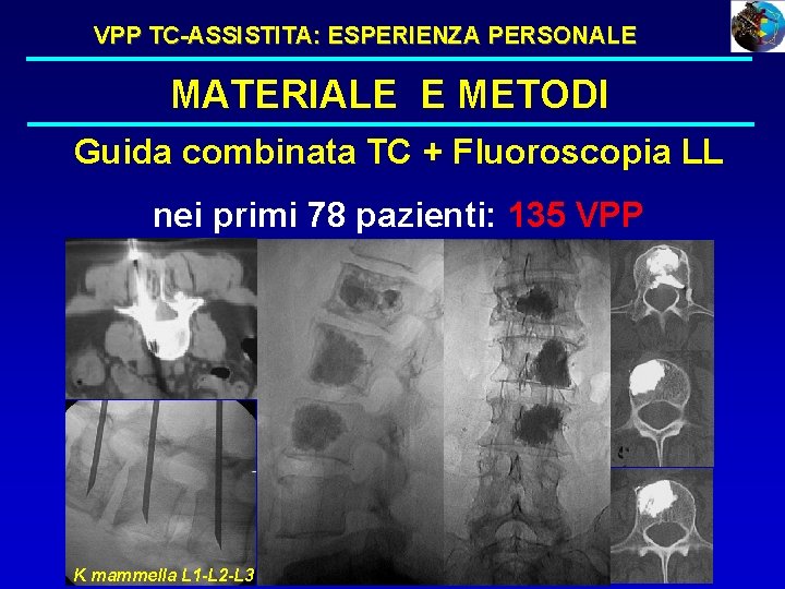 VPP TC-ASSISTITA: ESPERIENZA PERSONALE MATERIALE E METODI Guida combinata TC + Fluoroscopia LL nei VPP TC-ASSISTITA: ESPERIENZA PERSONALE MATERIALE E METODI Guida combinata TC + Fluoroscopia LL nei