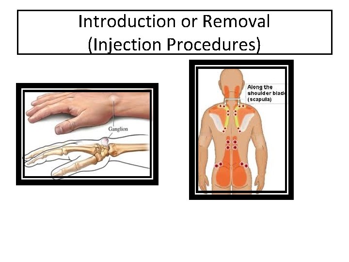 Introduction or Removal (Injection Procedures) 