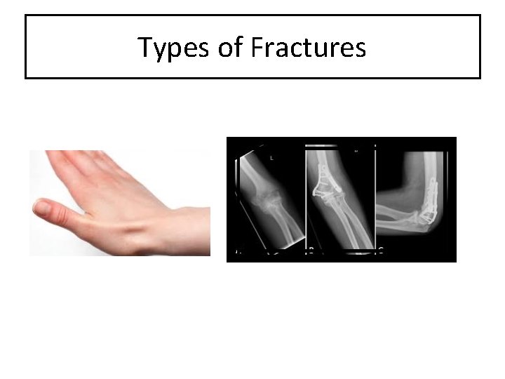 Types of Fractures 