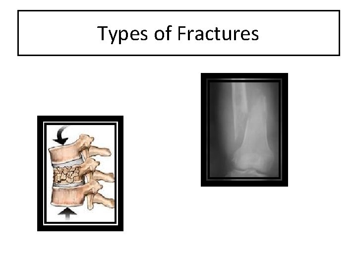 Types of Fractures 