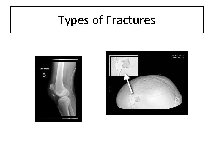 Types of Fractures 