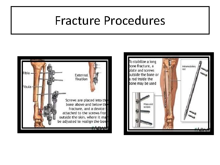 Fracture Procedures 