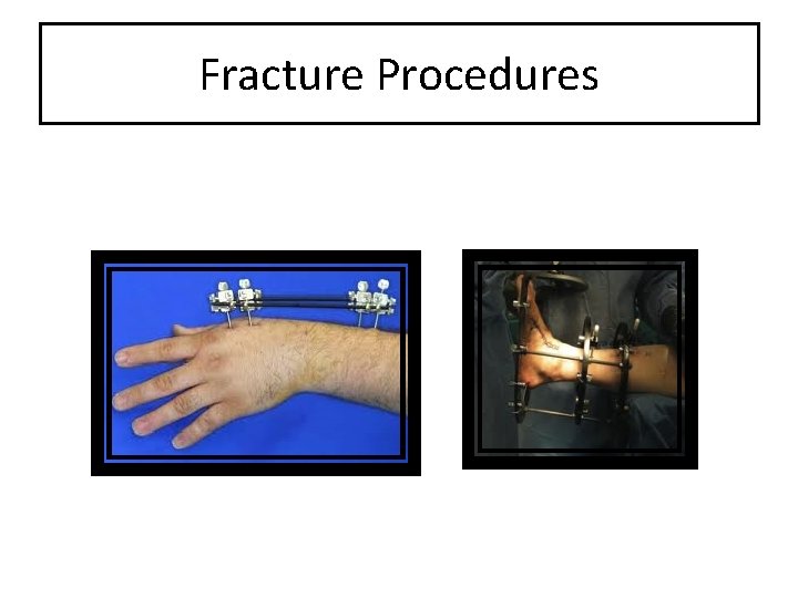 Fracture Procedures 