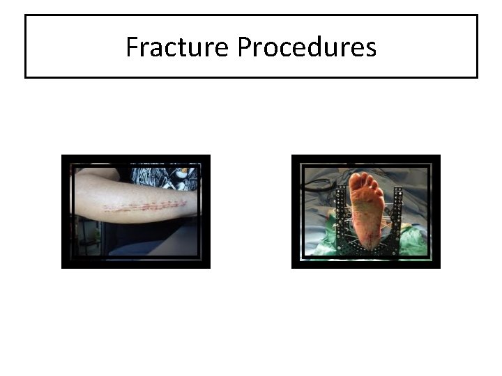 Fracture Procedures 