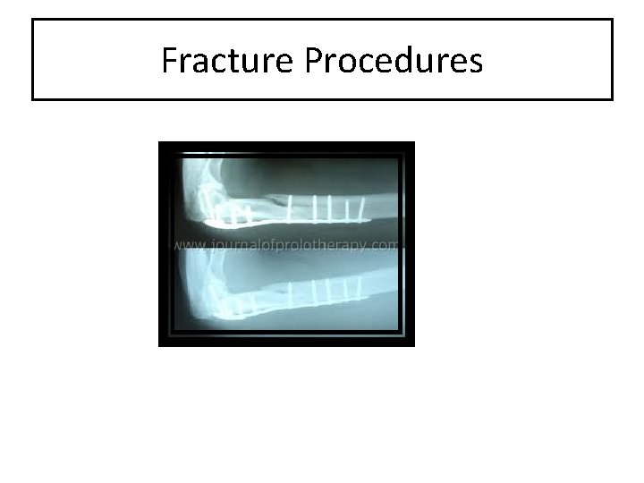 Fracture Procedures 