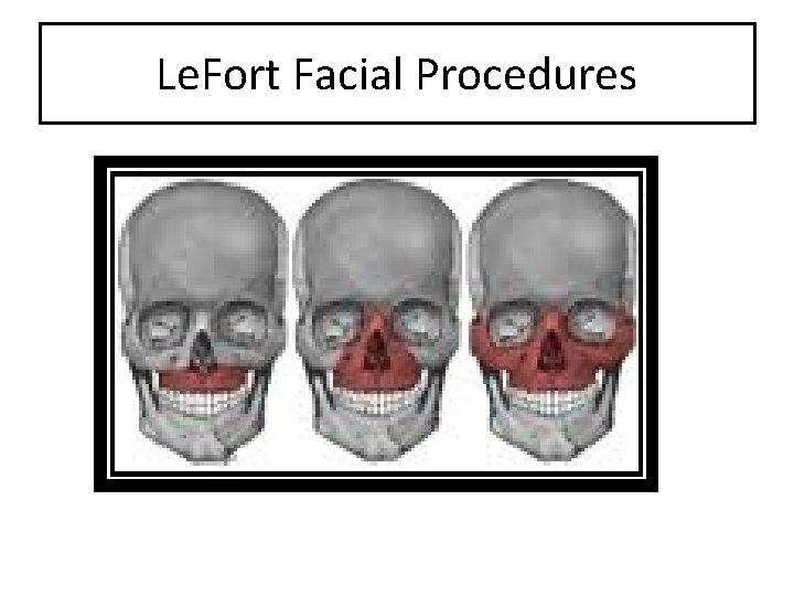 Le. Fort Facial Procedures 