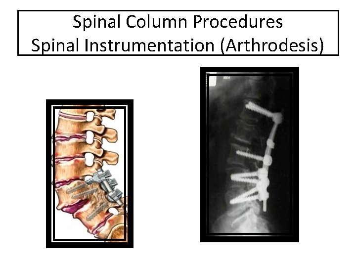 Spinal Column Procedures Spinal Instrumentation (Arthrodesis) 