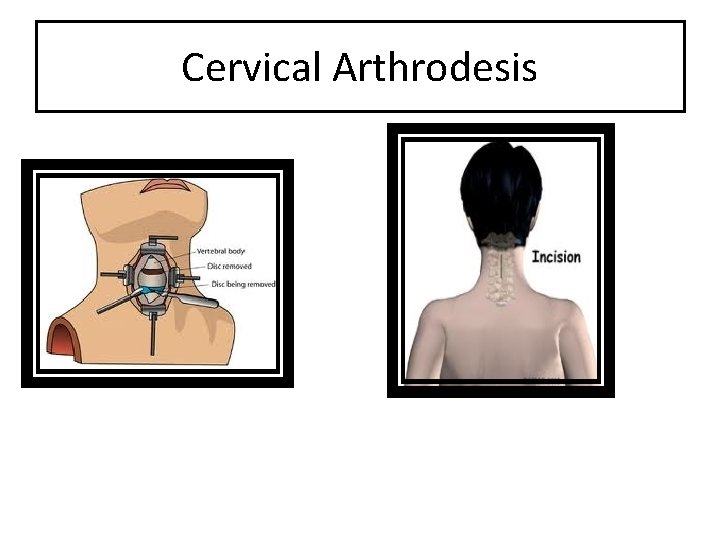 Cervical Arthrodesis 