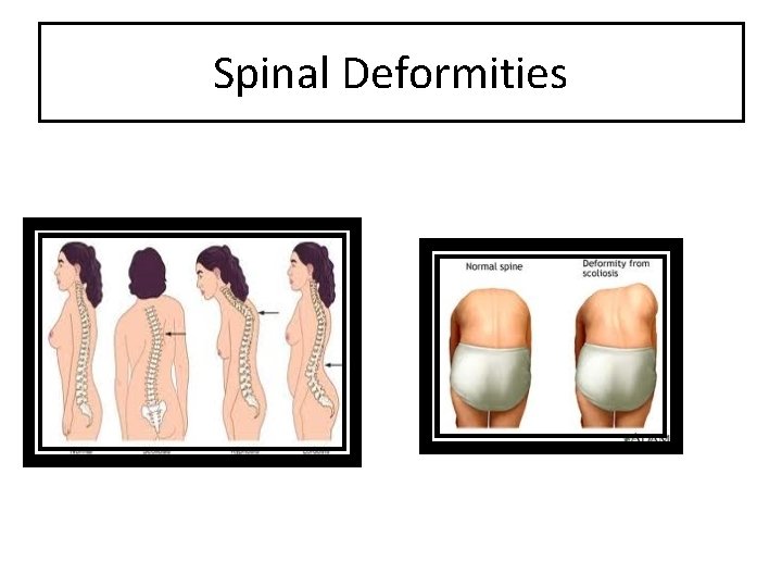 Spinal Deformities 