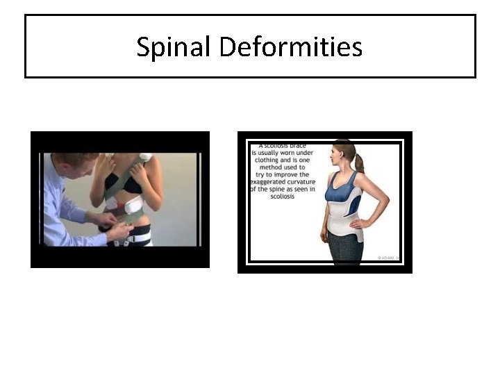 Spinal Deformities 