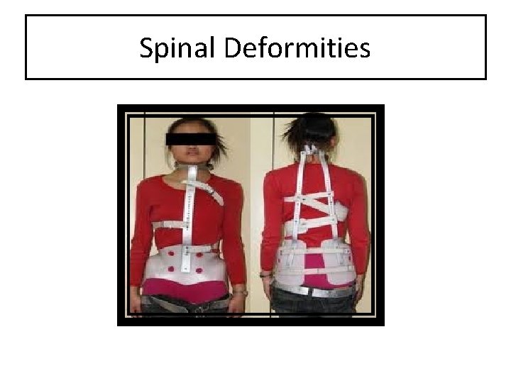 Spinal Deformities 