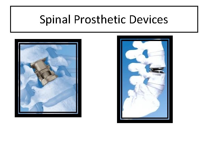 Spinal Prosthetic Devices 