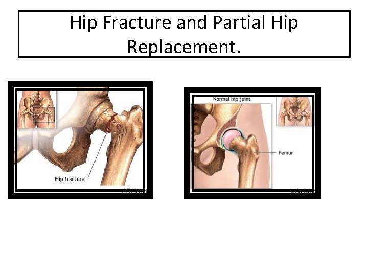 Hip Fracture and Partial Hip Replacement. 