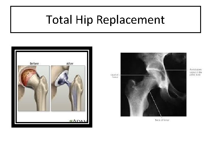 Total Hip Replacement 