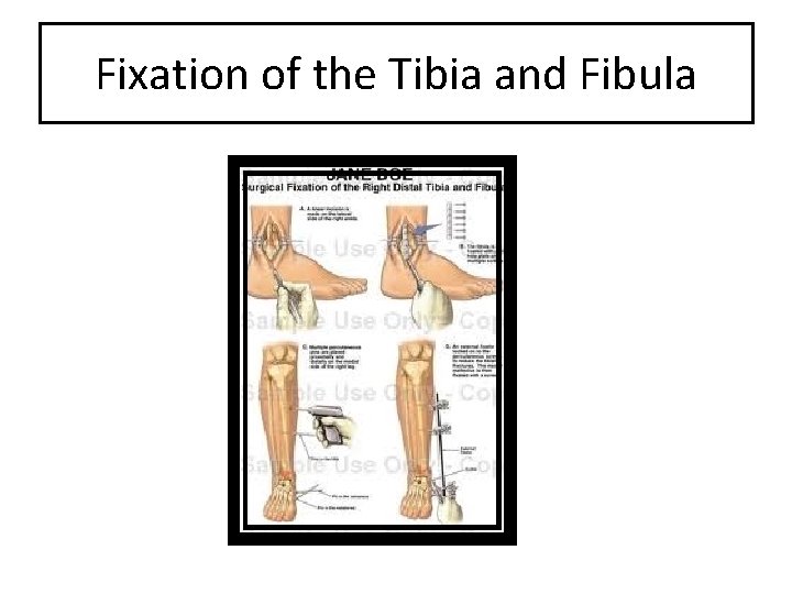 Fixation of the Tibia and Fibula 