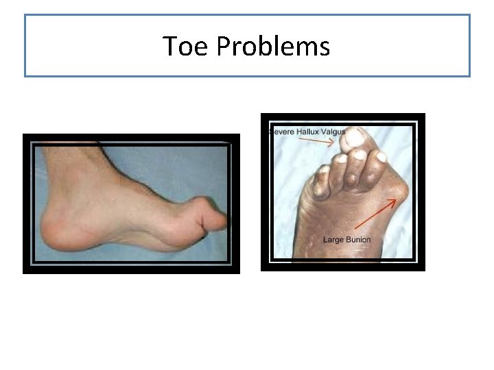 Toe Problems 