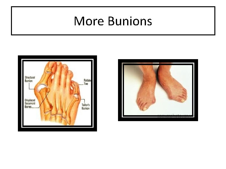 More Bunions 