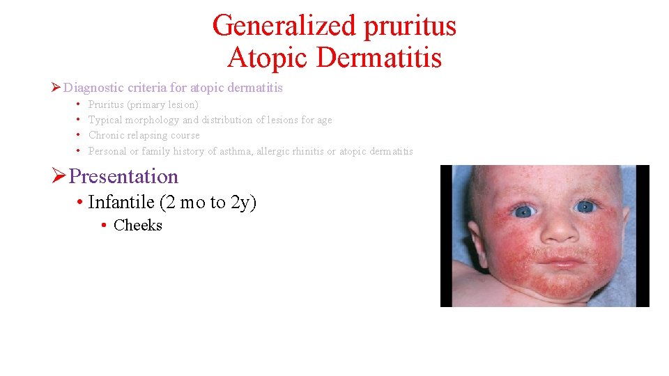 Generalized pruritus Atopic Dermatitis Ø Diagnostic criteria for atopic dermatitis • • Pruritus (primary