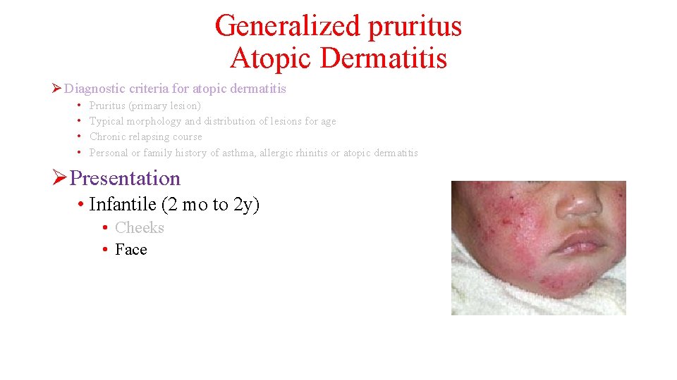 Generalized pruritus Atopic Dermatitis Ø Diagnostic criteria for atopic dermatitis • • Pruritus (primary