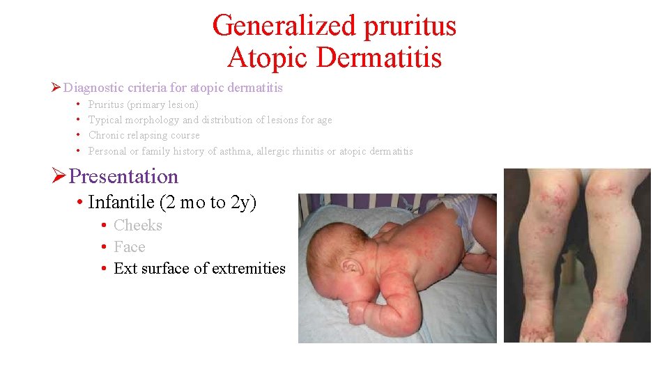 Generalized pruritus Atopic Dermatitis Ø Diagnostic criteria for atopic dermatitis • • Pruritus (primary