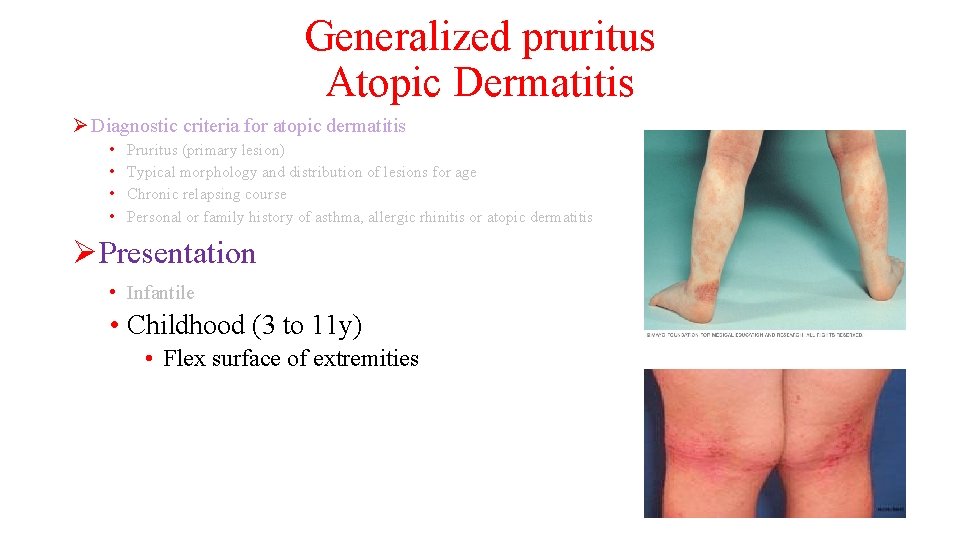 Generalized pruritus Atopic Dermatitis Ø Diagnostic criteria for atopic dermatitis • • Pruritus (primary