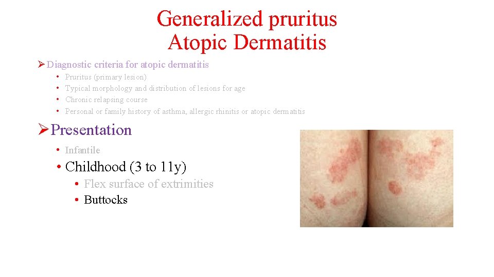 Generalized pruritus Atopic Dermatitis Ø Diagnostic criteria for atopic dermatitis • • Pruritus (primary
