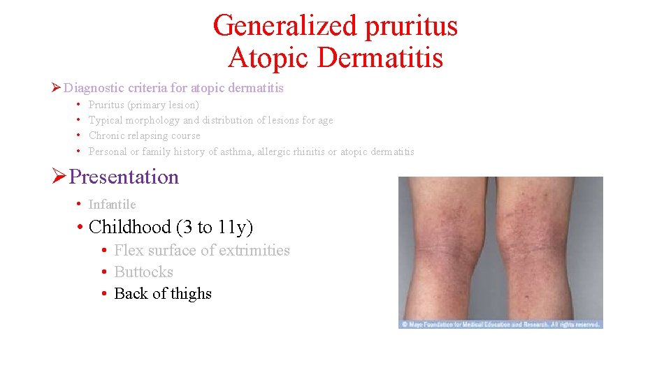 Generalized pruritus Atopic Dermatitis Ø Diagnostic criteria for atopic dermatitis • • Pruritus (primary