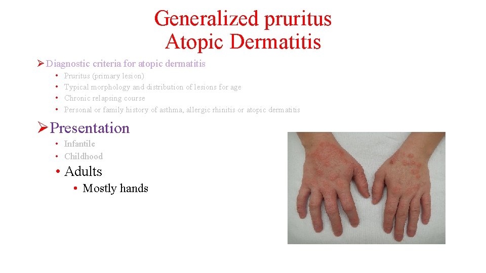 Generalized pruritus Atopic Dermatitis Ø Diagnostic criteria for atopic dermatitis • • Pruritus (primary