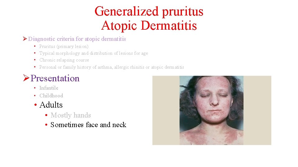 Generalized pruritus Atopic Dermatitis Ø Diagnostic criteria for atopic dermatitis • • Pruritus (primary