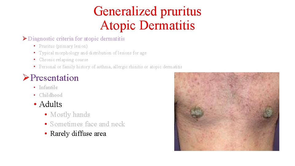 Generalized pruritus Atopic Dermatitis Ø Diagnostic criteria for atopic dermatitis • • Pruritus (primary