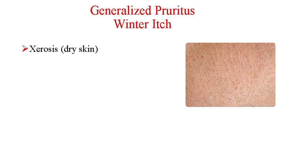 Generalized Pruritus Winter Itch ØXerosis (dry skin) 