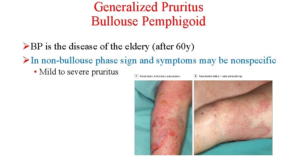 Generalized Pruritus Bullouse Pemphigoid ØBP is the disease of the eldery (after 60 y)