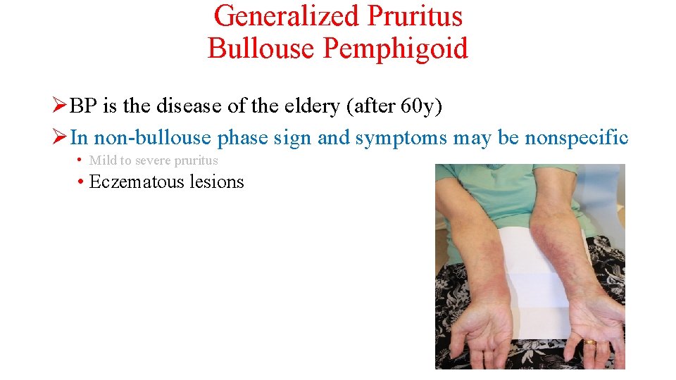 Generalized Pruritus Bullouse Pemphigoid ØBP is the disease of the eldery (after 60 y)