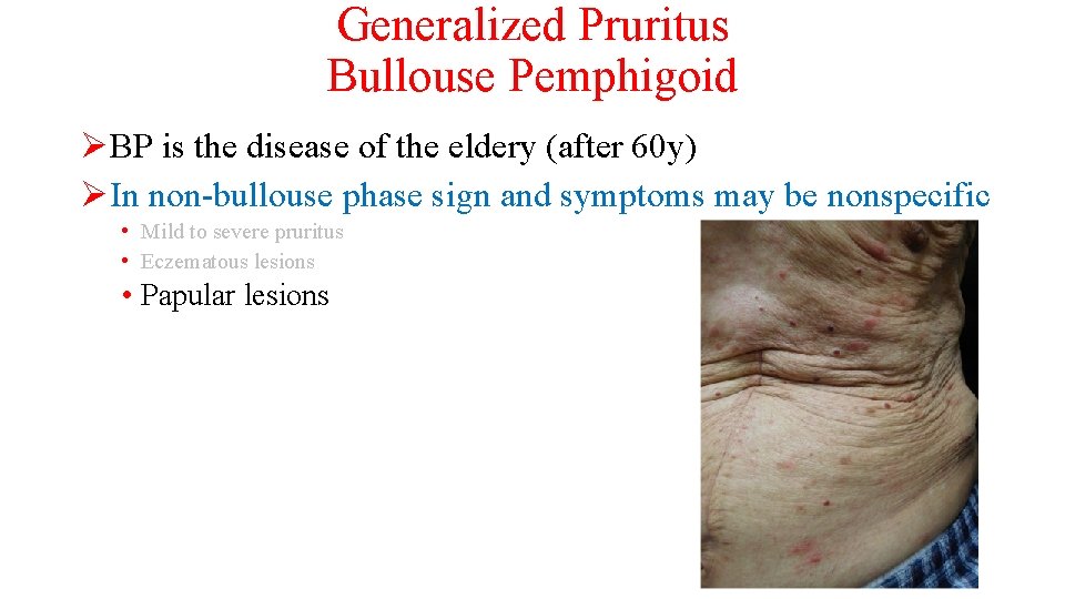 Generalized Pruritus Bullouse Pemphigoid ØBP is the disease of the eldery (after 60 y)