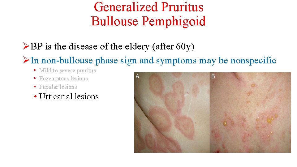 Generalized Pruritus Bullouse Pemphigoid ØBP is the disease of the eldery (after 60 y)