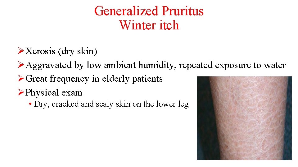 Generalized Pruritus Winter itch ØXerosis (dry skin) ØAggravated by low ambient humidity, repeated exposure