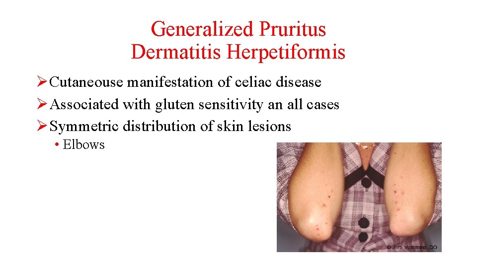 Generalized Pruritus Dermatitis Herpetiformis ØCutaneouse manifestation of celiac disease ØAssociated with gluten sensitivity an