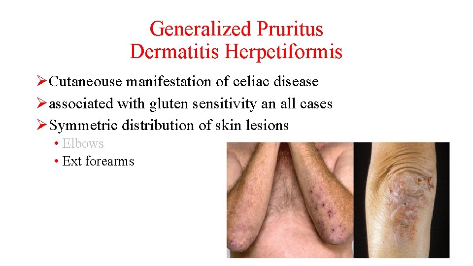 Generalized Pruritus Dermatitis Herpetiformis ØCutaneouse manifestation of celiac disease Øassociated with gluten sensitivity an