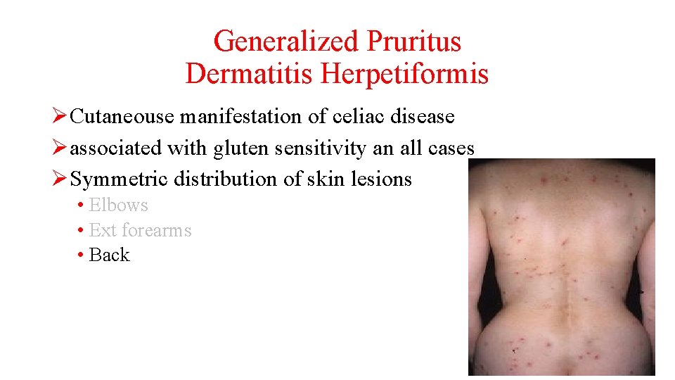 Generalized Pruritus Dermatitis Herpetiformis ØCutaneouse manifestation of celiac disease Øassociated with gluten sensitivity an