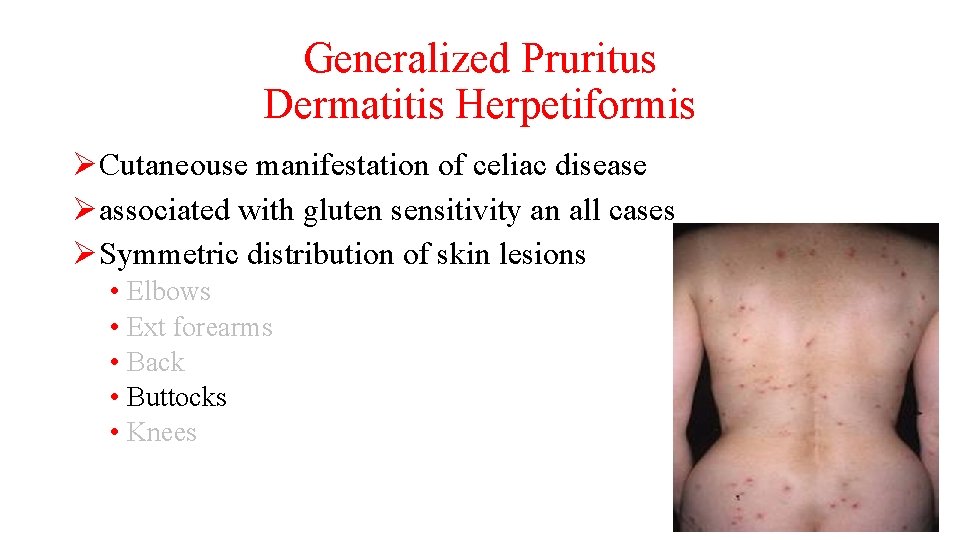 Generalized Pruritus Dermatitis Herpetiformis ØCutaneouse manifestation of celiac disease Øassociated with gluten sensitivity an