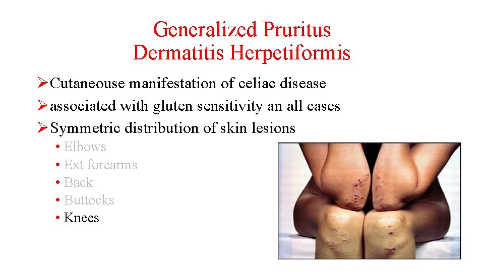 Generalized Pruritus Dermatitis Herpetiformis ØCutaneouse manifestation of celiac disease Øassociated with gluten sensitivity an