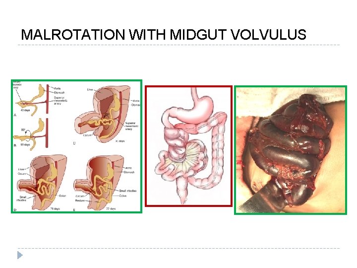 MALROTATION WITH MIDGUT VOLVULUS 