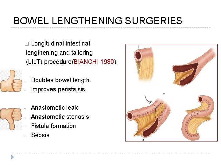 BOWEL LENGTHENING SURGERIES Longitudinal intestinal lengthening and tailoring � (LILT) procedure(BIANCHI 1980). - Doubles