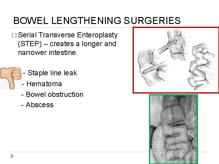 BOWEL LENGTHENING SURGERIES � Serial Transverse Enteroplasty (STEP) – creates a longer and narrower