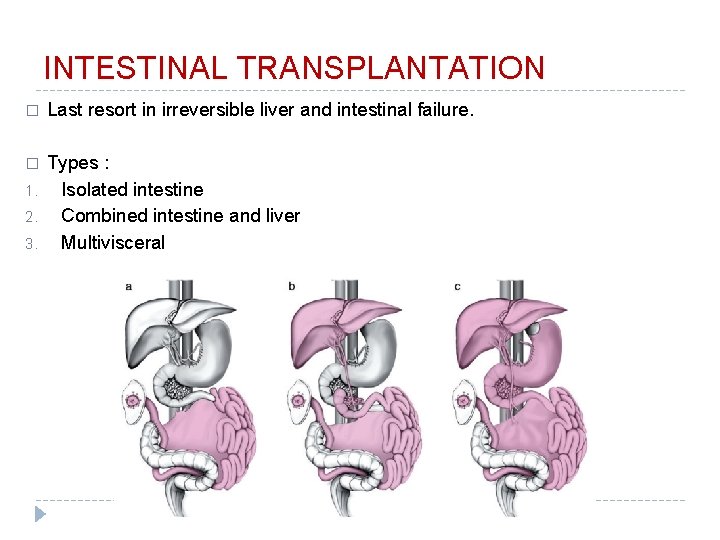 INTESTINAL TRANSPLANTATION � Last resort in irreversible liver and intestinal failure. � Types :